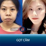 Vline 3D jaw reduction surgery- Solution for square jaw