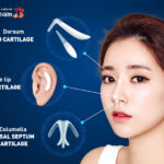 4D structural rhinoplasty
