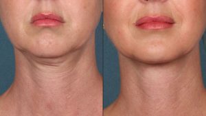 Kangnam’s Neck Lift – The Most Modern Solution to Eliminate Neck Wrinkles