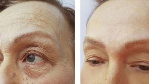 Kangnam Aesthetic Hospital Explains the Forehead Lift Procedure