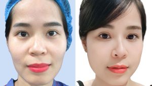 Fat Grafting for Facial Volume Restoration – The Secret to Rejuvenation with Kangnam
