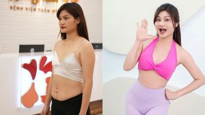 Kangnam’s Liposuction 360 – Achieve a Slim Waist and Ideal Shape Instantly