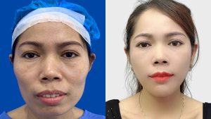 A-Z Guide on Jaw Contouring with Kangnam Aesthetic Hospital