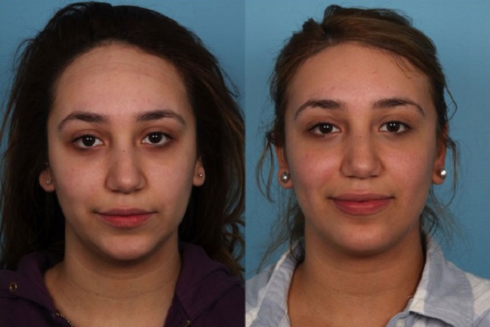 Hairline Lowering Surgery is Considered Safe for Clients 