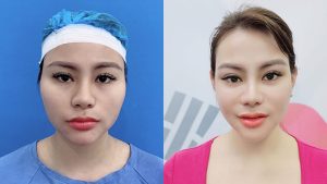 Cheekbone Reduction – Discover the Korean-Standard Surgical Procedure with Kangnam