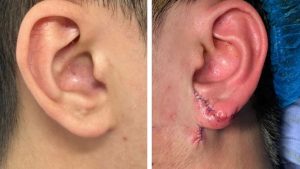 Earlobe Reconstruction Surgery – A Miraculous Process That Brings a New Life to Gia Huy