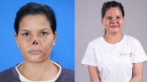 Lo Thi Le and Her Journey to Find Her ‘Missing’ Nose