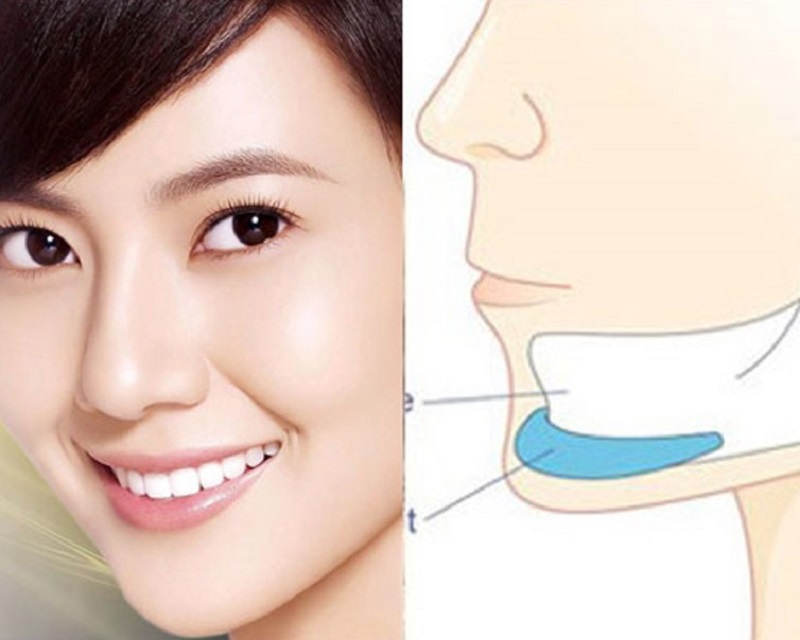 The chin augmentation method uses implant materials to enhance the projection of the chin.