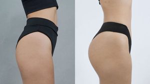 Buttock Augmentation – The Solution for a Full, Attractive Figure