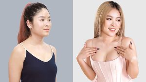 Breast Augmentation by Kangnam: Creating a round, beautiful bust for life