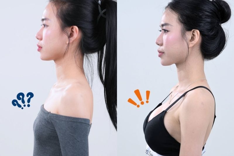 Natural-looking breasts