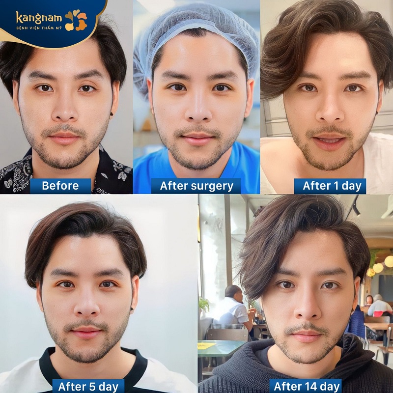 Combining eye aesthetic procedures helps create larger, well-defined eyelids.