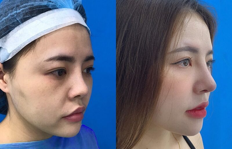 Using high-quality nasal cartilage to correct a damaged nose.