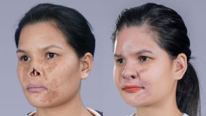 Doctor Richard Huy Restores the ‘Missing’ Nose for a Gen Z Girl