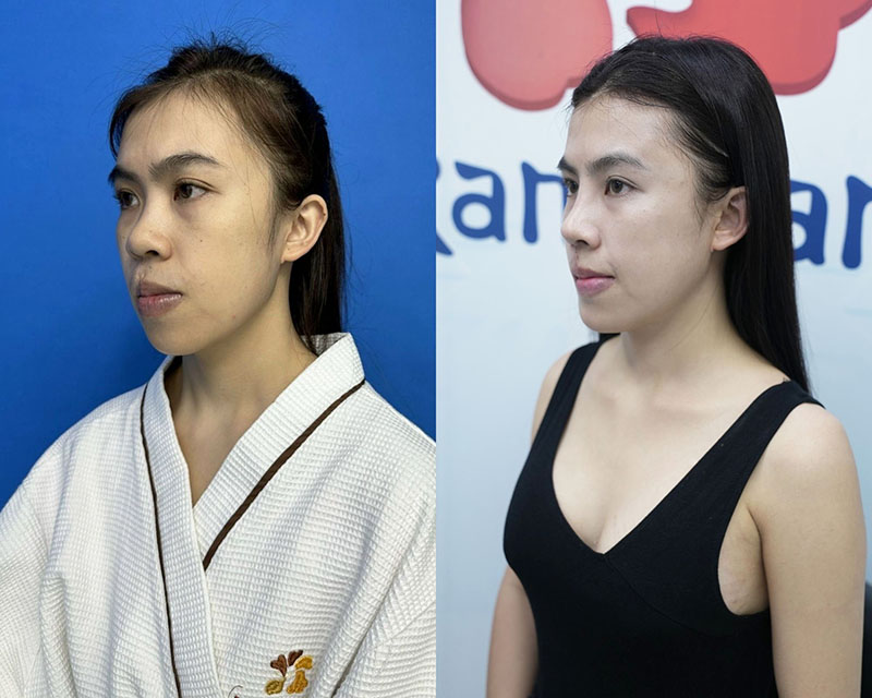 Thanh Tam's nose shape before and after surgery
