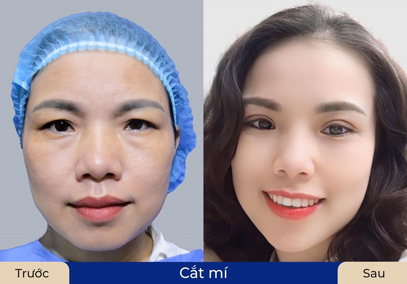 Customers' eyes are more youthful after eyelid surgery at Dr. Richard Huy 