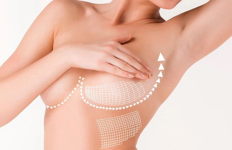 Breast lift surgery is the optimal solution for women 
