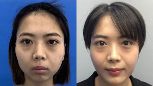 Sliding Genioplasty – Beautiful and trendy V-line chin