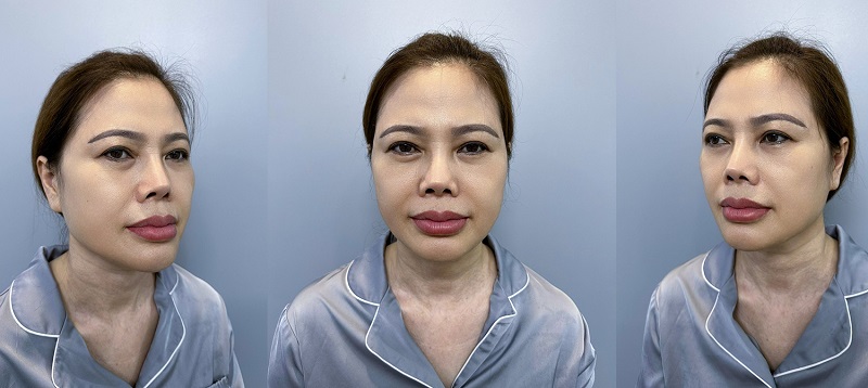 Vietnamese from Germany returns home for cosmetic surgery with amazing results