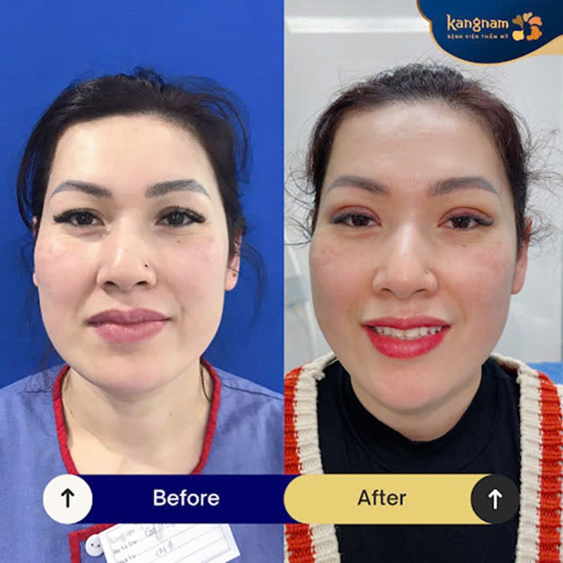Eyelid surgery – a reputable cosmetic beauty service in Hanoi.