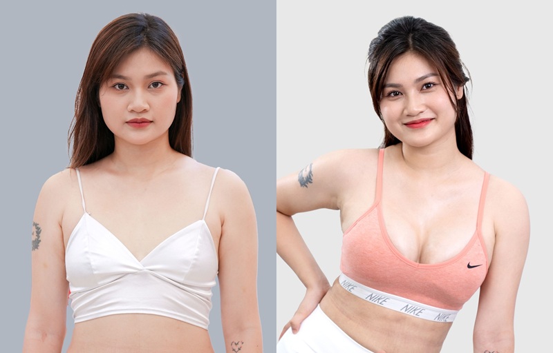 Revision breast augmentation costs more than the first-time breast augmentation.