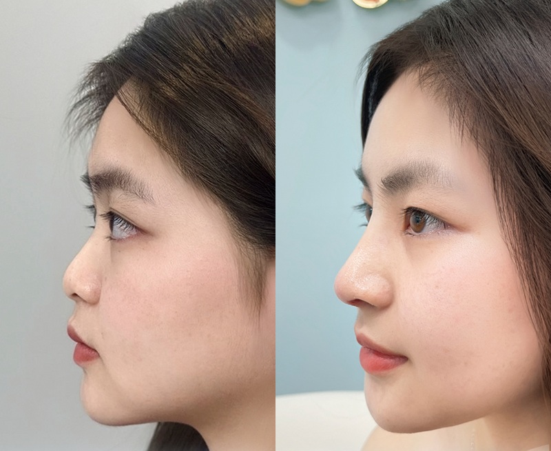 A nose lift usually settles into shape safely and relatively quickly after some time.