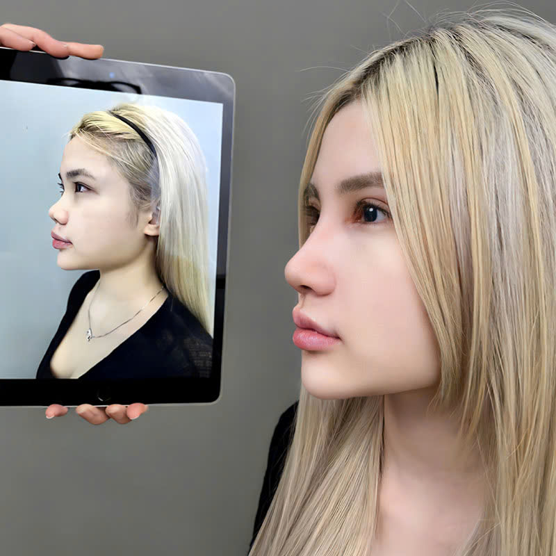 The patient’s nose is no longer swollen or painful and appears in its natural shape.