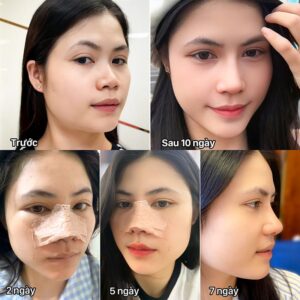 How Soon Can You Fly After Rhinoplasty? The safe time to travel by plane for international patients