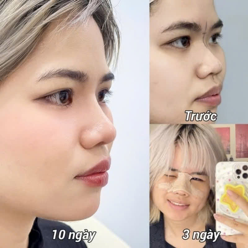 The type of rhinoplasty performed can influence how soon a patient is able to fly.