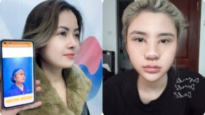 Post-Operative Care After Rhinoplasty – A Guide for International Patients