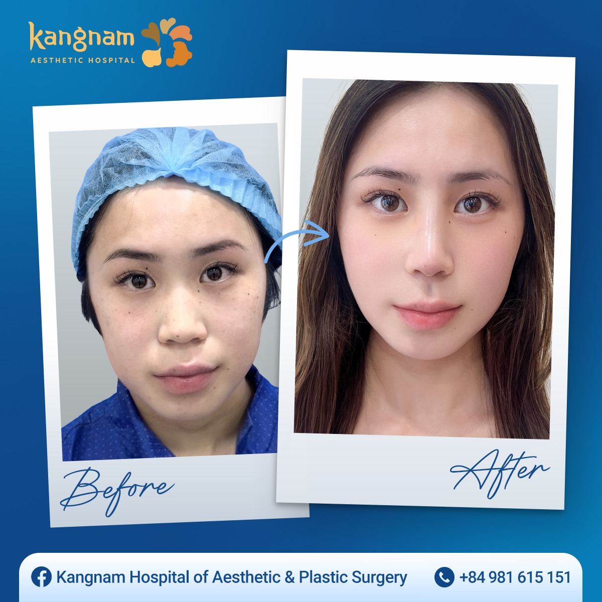 Before and after rhinoplasty images for international clients