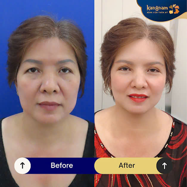 Facelift helps create a more youthful and balanced appearance
