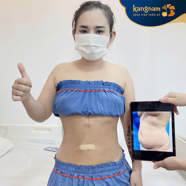 Liposuction helps achieve a slimmer, firmer body shape