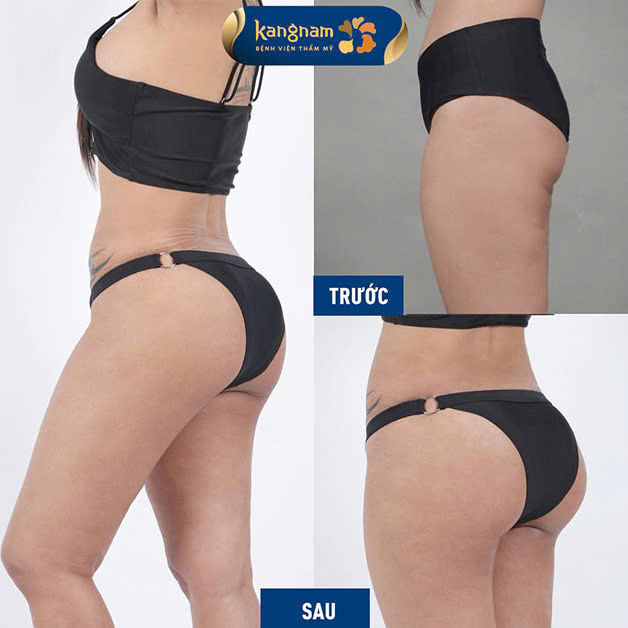 Buttock augmentation for a fuller, rounder, natural look