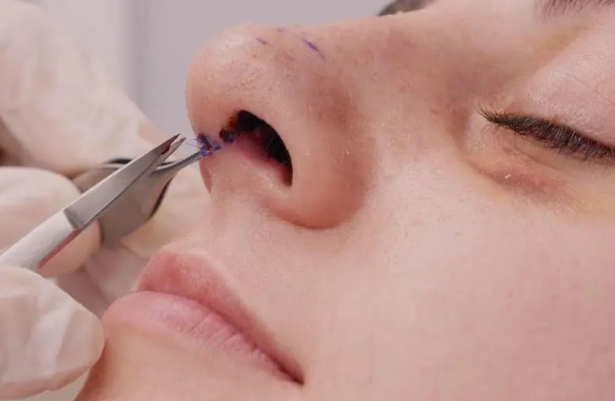 The doctor personally removes the stitches, ensuring safety and preventing complications.