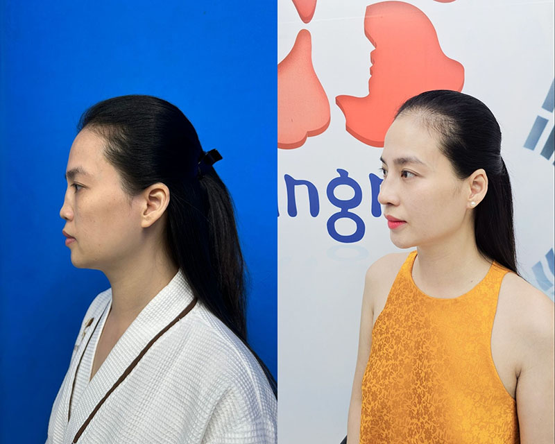 Successful reconstructive surgery to correct a previously failed rhinoplasty.