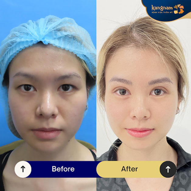 The cost of eyelid surgery in Vietnam is reasonable.