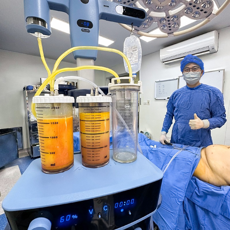 Modern liposuction technology ensures safety.