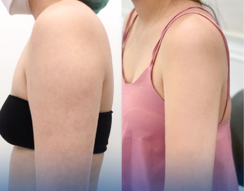 The liposuction procedure is quick, shortening the recovery time.