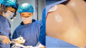 Top 4 Boob Job Surgeons in Vietnam – Trusted Breast Augmentation Doctors