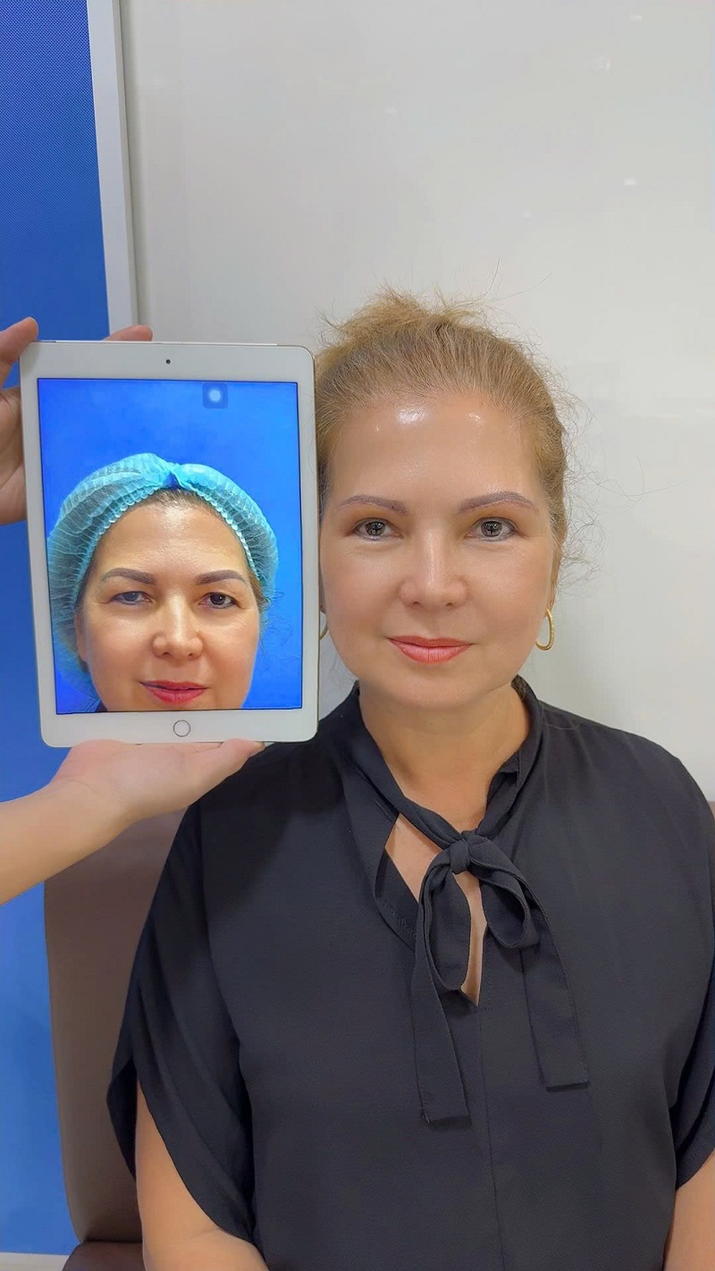 Customer has big, round, balanced, harmonious eyes, no scars left after 1 month of eyelid surgery.