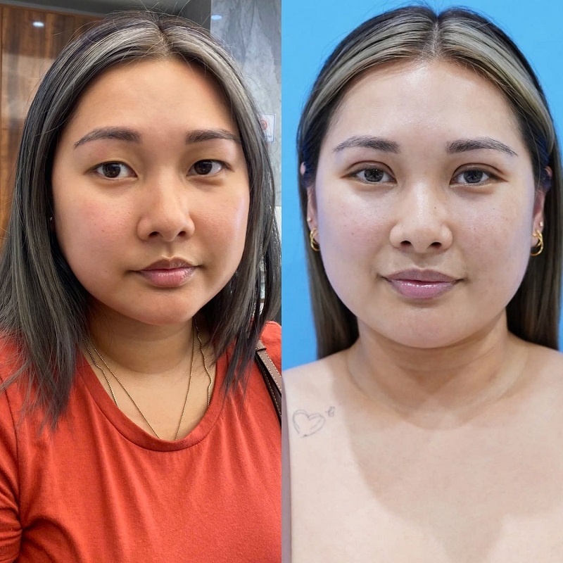 Clients experience faster recovery and achieve natural-looking eyelids more quickly.