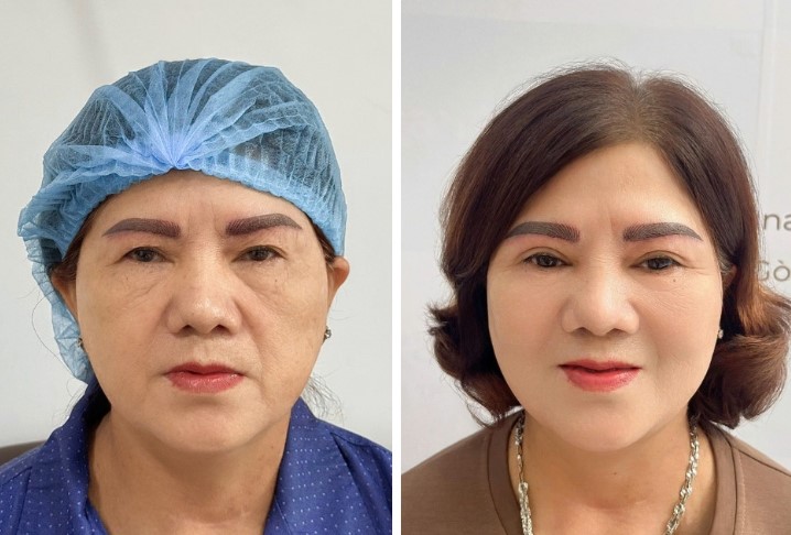 Create eyelid creases that are balanced and harmonious with the client's preferences.