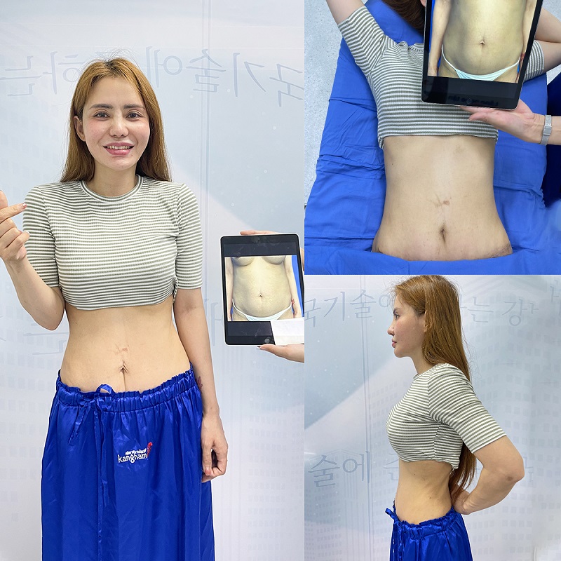After liposuction, the waistline becomes slimmer and more balanced quickly.