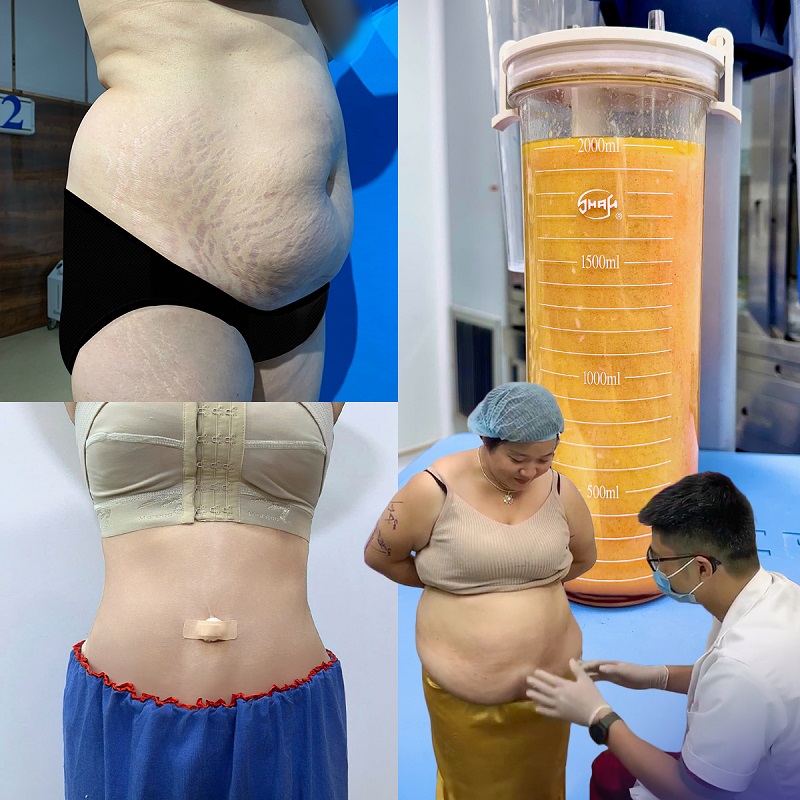 At a reputable liposuction clinic, the doctor will remove excess fat in a way that is appropriate for each individual's body.