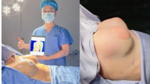 Top 3 reputable breast augmentation clinics in Vietnam