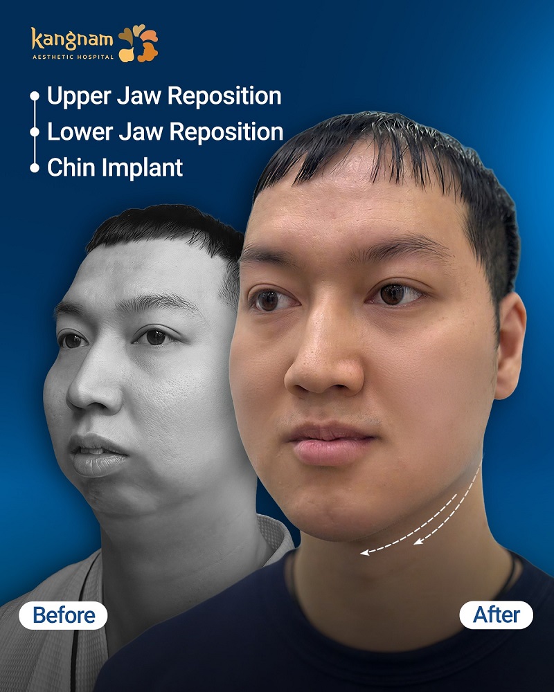 Facial and jaw surgery creates a balanced and harmonious face.