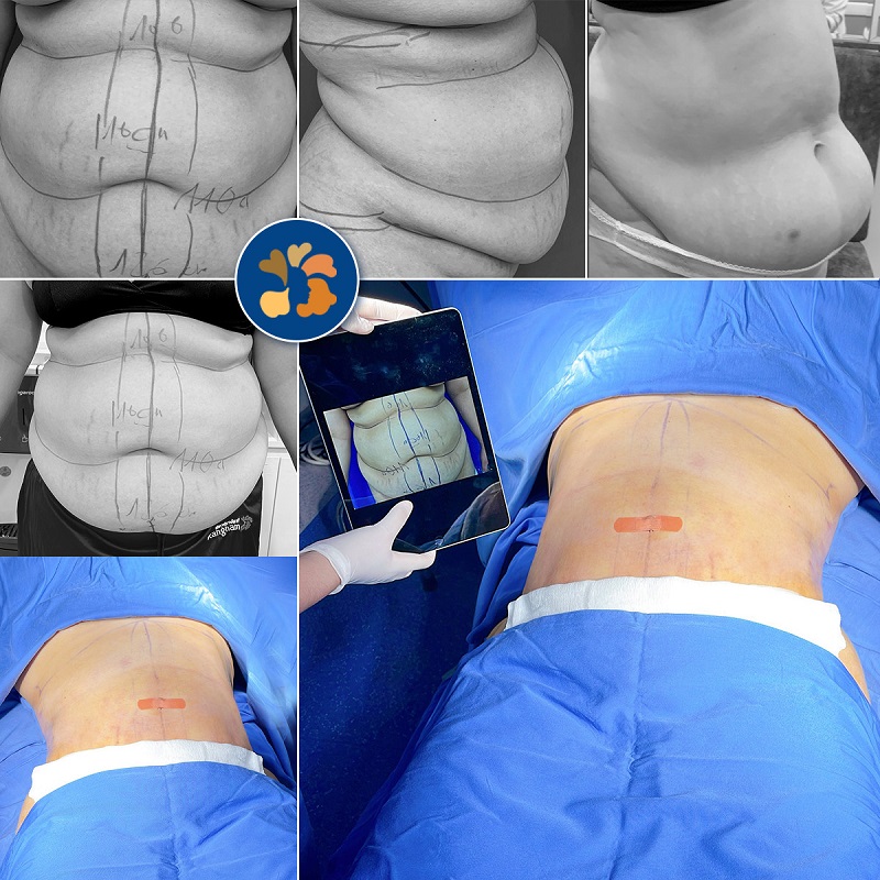 Liposuction of the abdomen removes excess fat quickly.