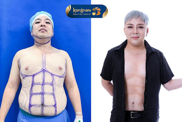 Safe liposuction, achieving fat reduction quickly in just one session