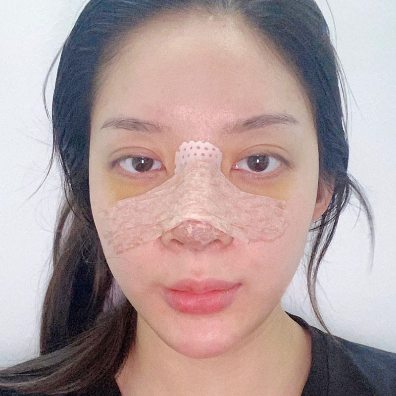 Maintain the nasal splint for the full duration as instructed.